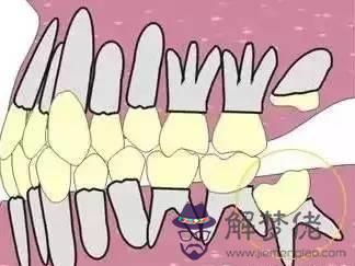 牙齒會影響運勢嗎：我的牙齒只有28顆，在相學上有什麼解釋麼？