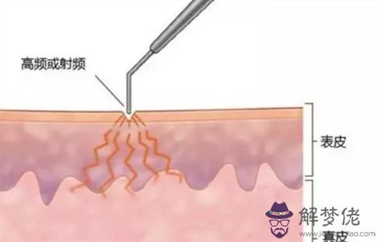 點痣會影響運勢嗎：去哪里可以點痣？