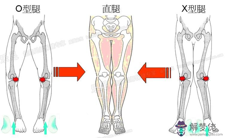 內八字腿怎麼矯正
