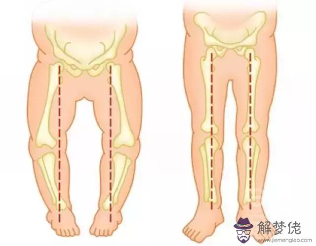 寶寶走路內八字原因