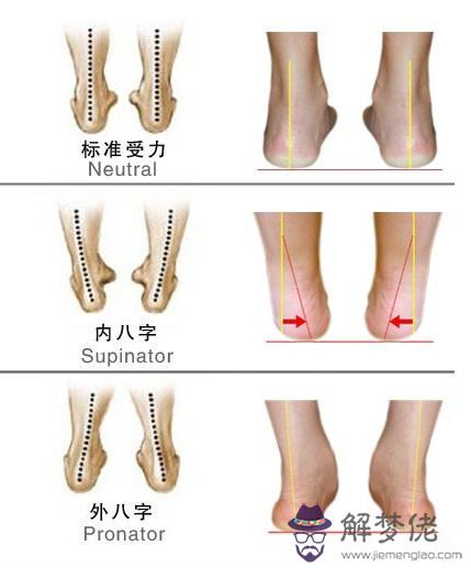 走路外八字矯正絕招：外八字腿怎麼矯正？