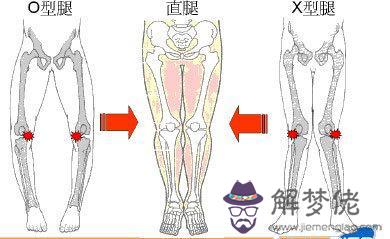 我兒子兩歲多了，走路一直有一只腳外撇，有些外八字，另外他腳后跟沒有長全，像少了一塊，是尖的。請問...