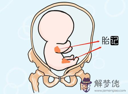 胎記的位置與命運