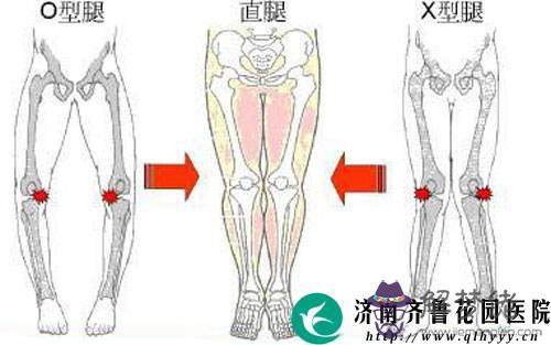 1歲寶寶走路右腳外八字