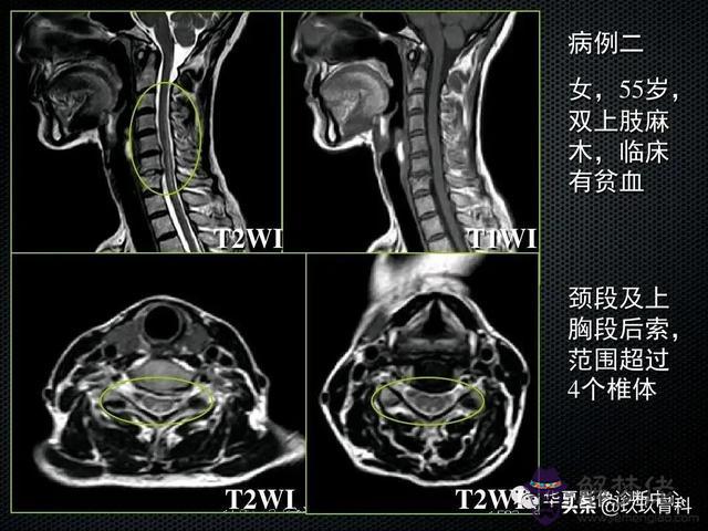 脊髓亞急性聯合變性八字征