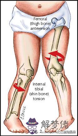 3歲小孩有點內八字該怎麼辦