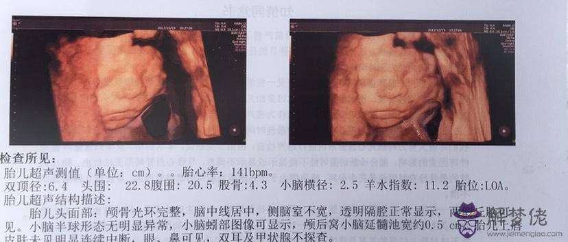 6、女寶的四維彩超單子:四維彩超單怎麼看是男孩還是女孩？