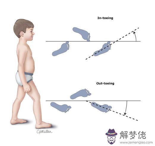 三歲孩子外八字腿怎麼矯正