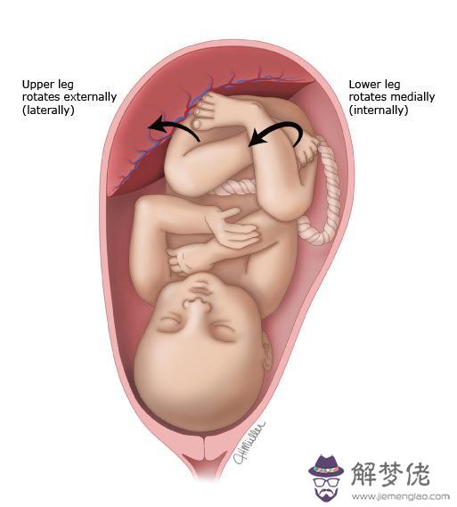 三歲孩子外八字腿怎麼矯正