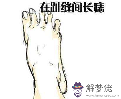 男的腳上有痣圖解 腳痣相看命運