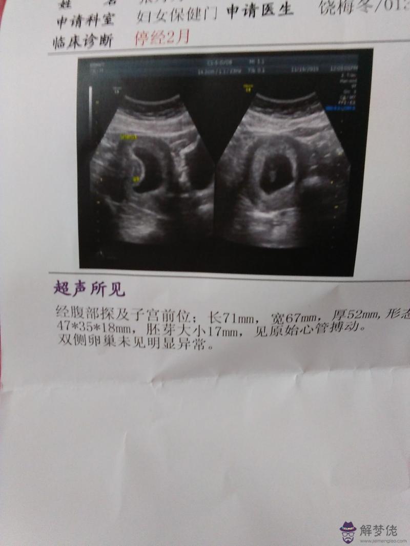 哪種孕囊屬于茄子型健康：孕囊形狀看男女準嗎？53×28×20是圓形的嗎