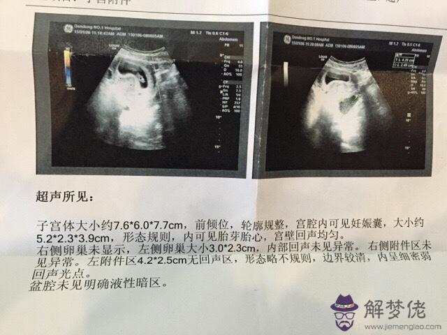 長孕囊和圓孕囊男孩還是女孩：懷孕58天檢測孕囊是長條的，是不是男孩？