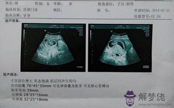 懷孕兩個月男孩孕囊圖：60天孕囊男孩嗎？