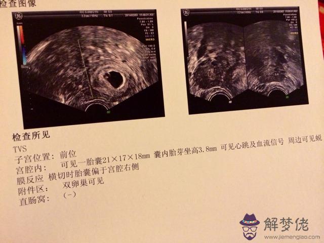 已生男孩孕囊圖片陰超：孕囊形狀怎麼看性別。附彩超圖片。