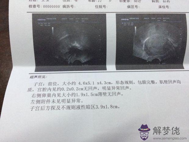 差不多兩個月的B超單大家可以判斷男女嗎。這個孕囊形狀是長還是圓呢