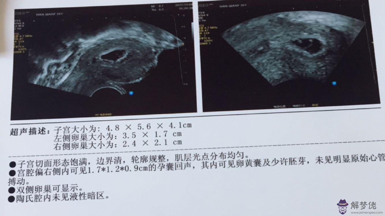 先兆的孕囊怎麼樣的：先兆，沒流掉，為什麼還看不到孕囊