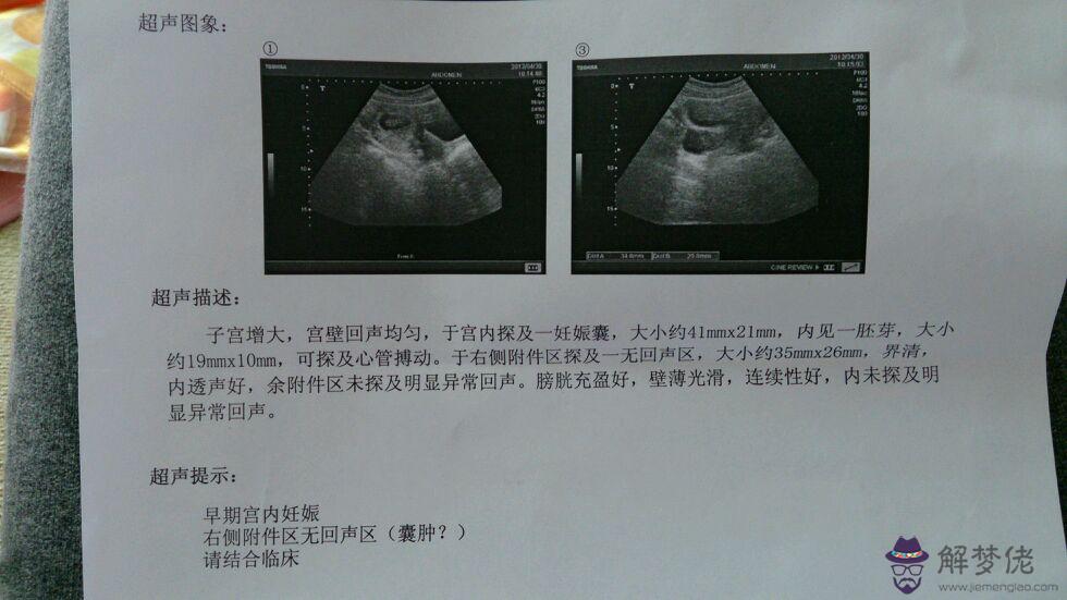 孕囊不好是什麼引起的：孕囊發育不好是什麼原因