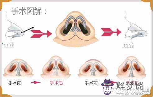 怎麼讓鼻頭變小:怎樣能使鼻頭變小?