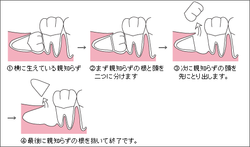 牙齒長智齒預示著什麼:長智齒預示未來好嗎